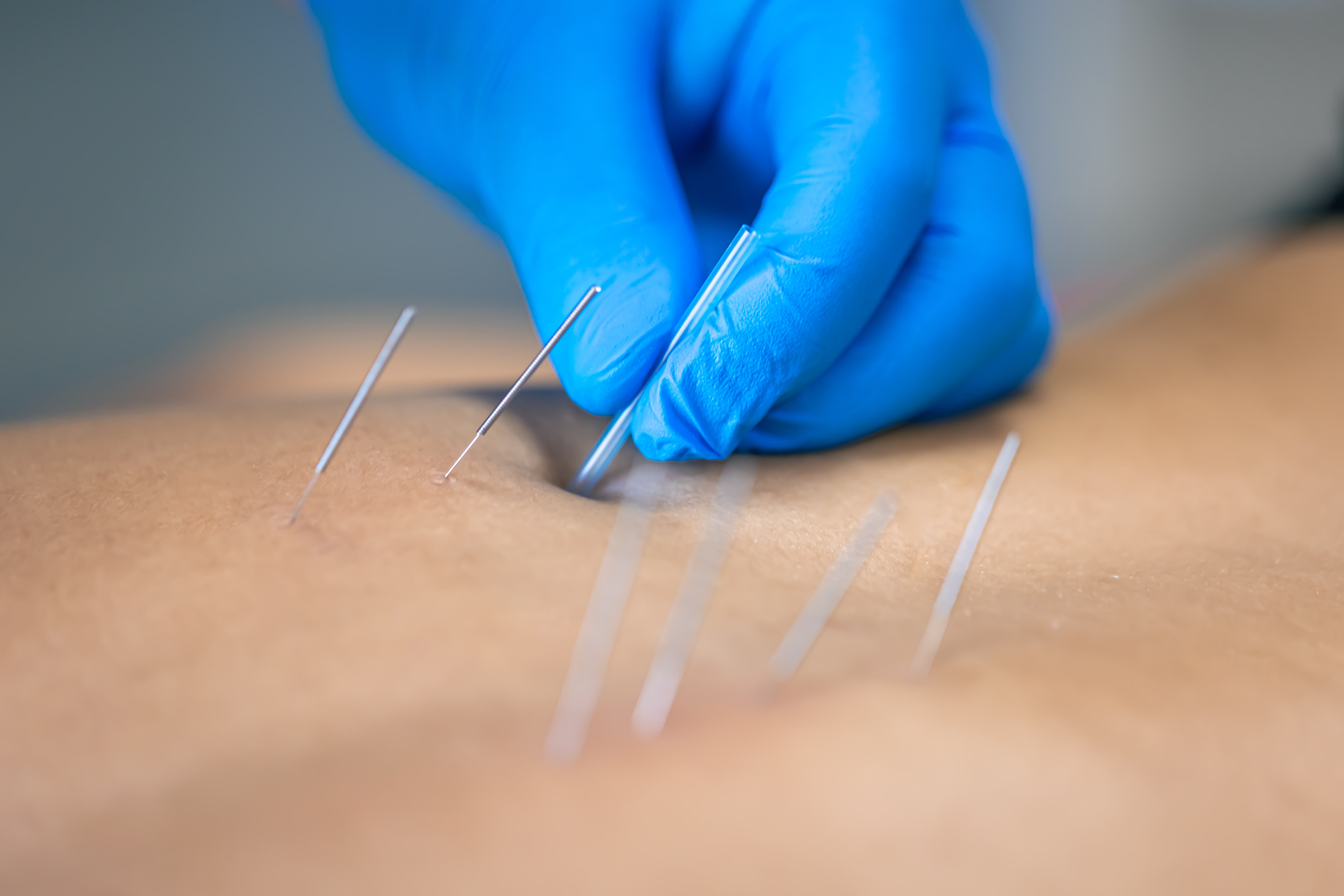 New Generation Approach in Physical Therapy: What is Dry Needling?